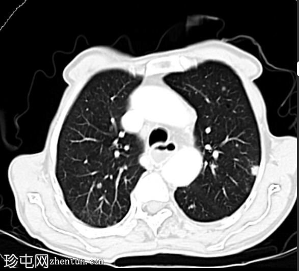 食管鳞状细胞癌伴肺和肝转移