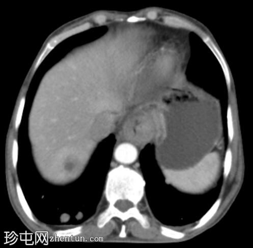 食管鳞状细胞癌伴肺和肝转移