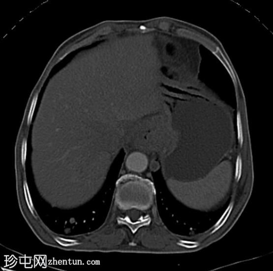 食管鳞状细胞癌伴肺和肝转移