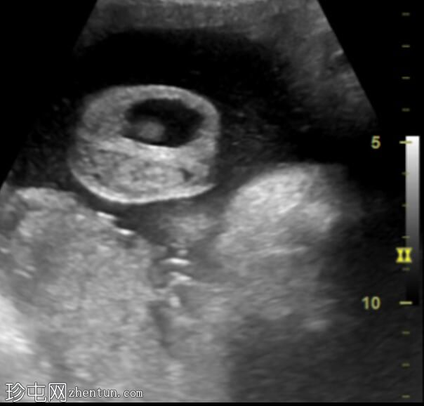 胎儿鞘膜积液
