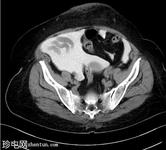下前腹壁导管周围采集（CT腹膜造影）