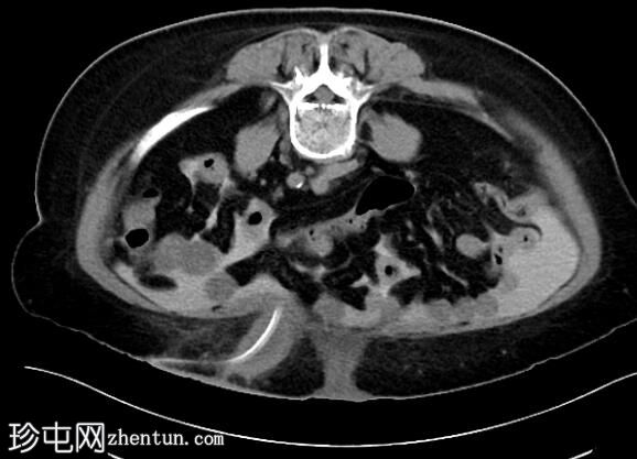 下前腹壁导管周围采集（CT腹膜造影）