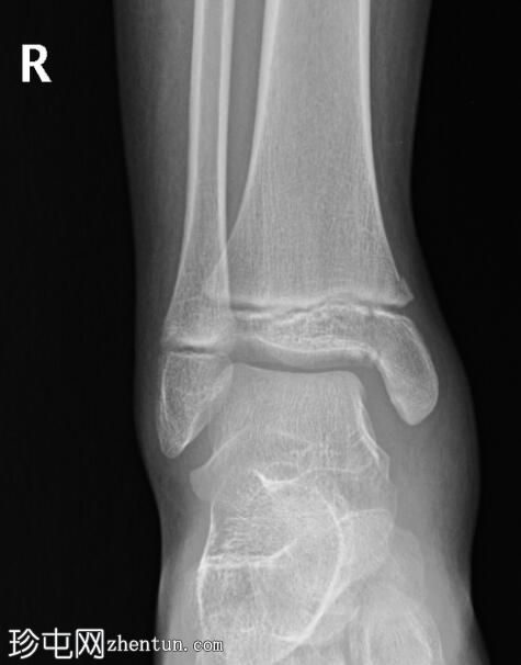 Salter-Harris IV 型胫骨远端骨折