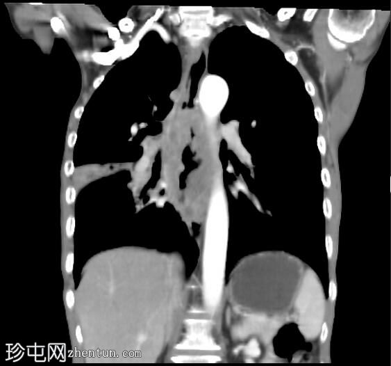 食管鳞状细胞癌伴主动脉侵犯