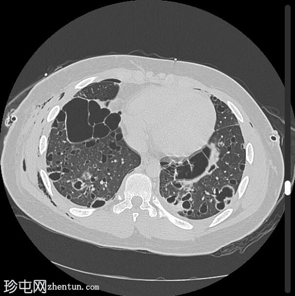 朗格汉斯细胞组织细胞增多症