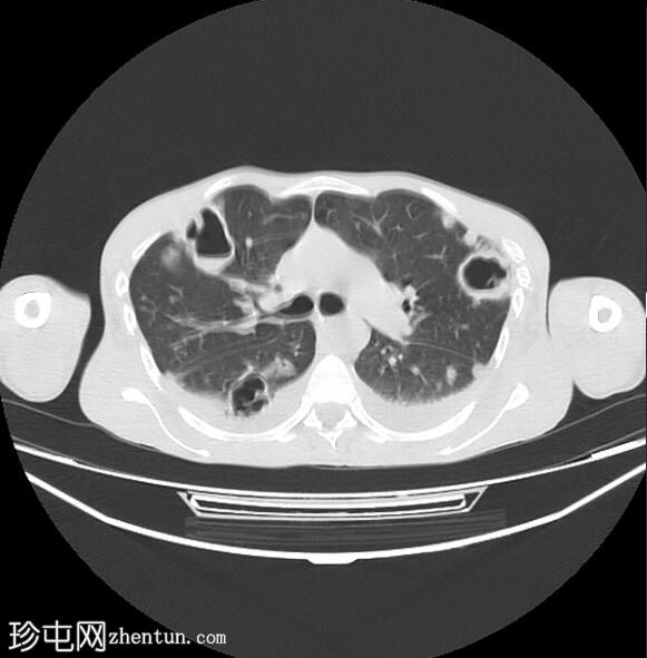 脓毒性肺栓塞