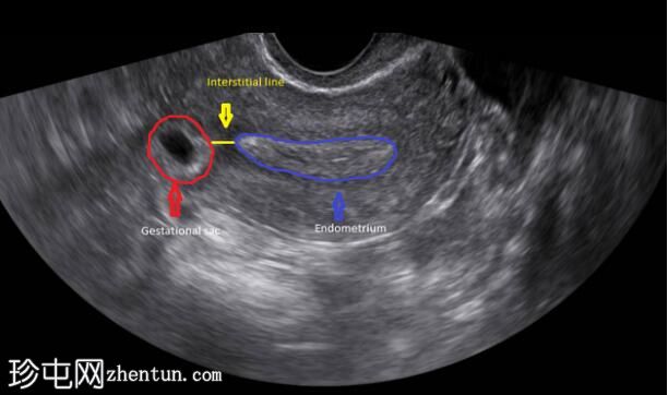 间质性宫外孕