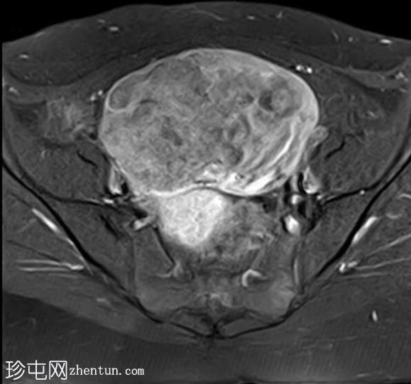 大型浆膜下平滑肌瘤