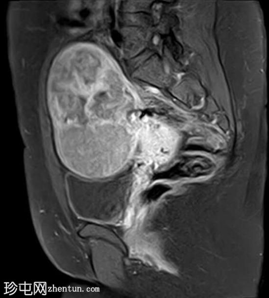 大型浆膜下平滑肌瘤