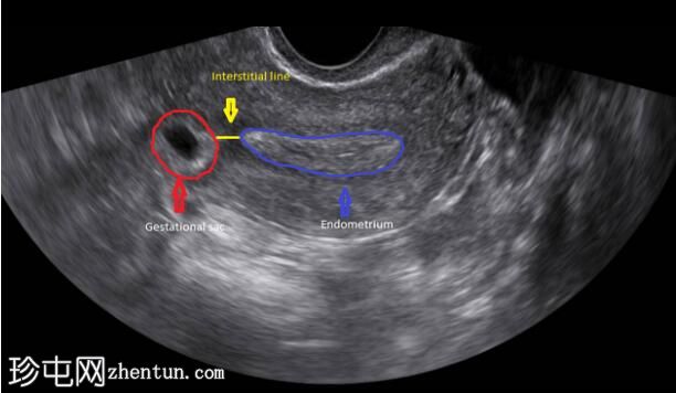 间质性宫外孕