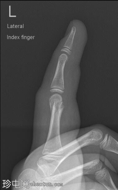 第2指近节指骨颈骨折