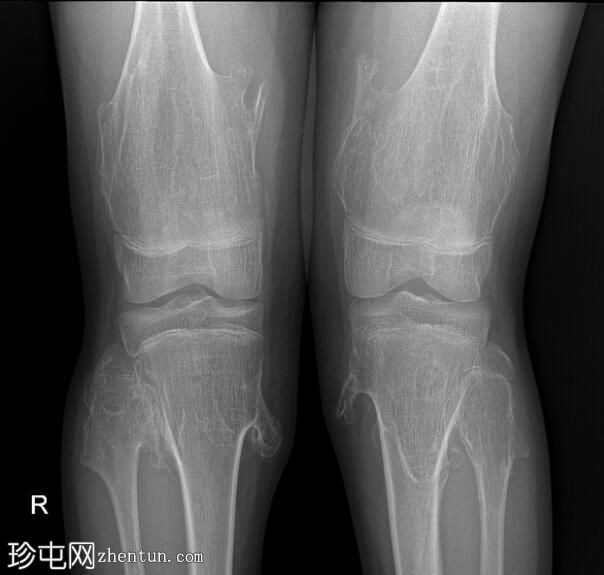 遗传性多发性外生骨疣