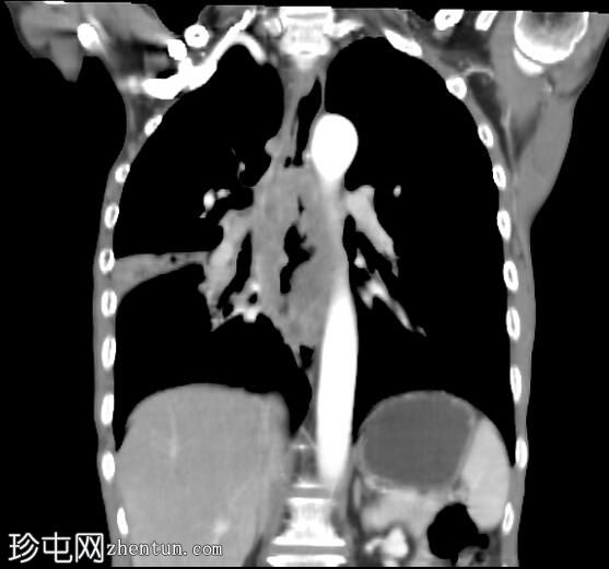 食管鳞状细胞癌伴主动脉侵犯