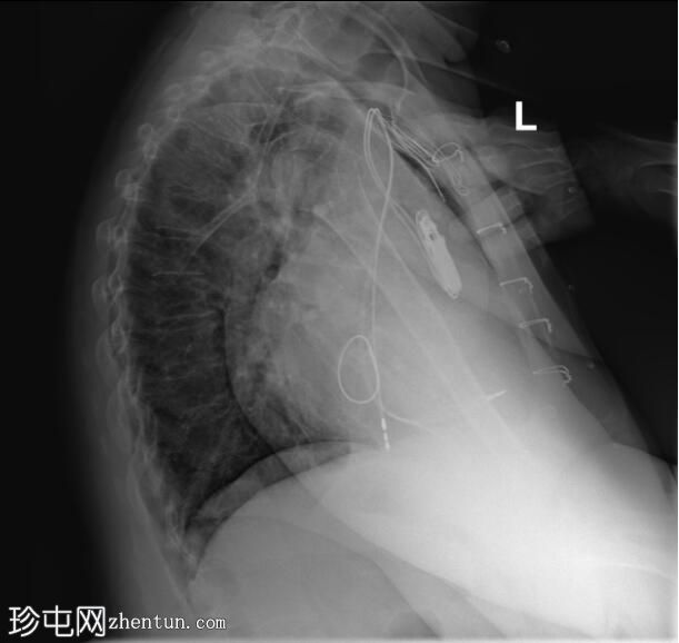 心脏起搏器 - 右心房导线脱落