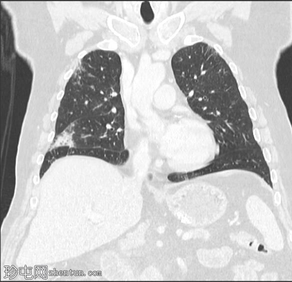 药物性肺损伤 - 白蛋白结合型紫杉醇/吉西他滨