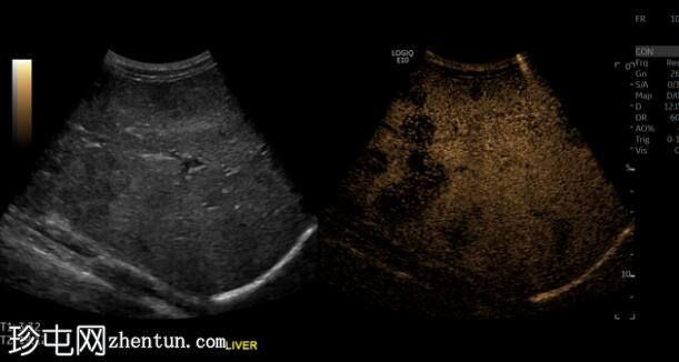 肝上皮性血管内皮瘤（CEUS）