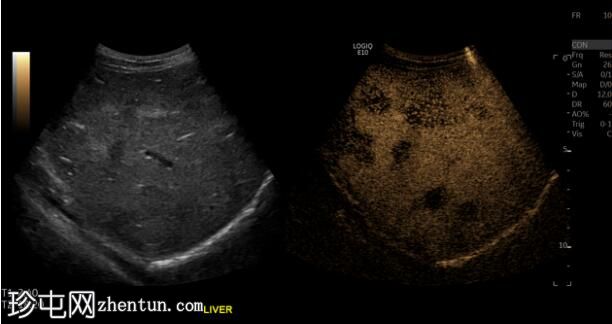 肝上皮性血管内皮瘤（CEUS）