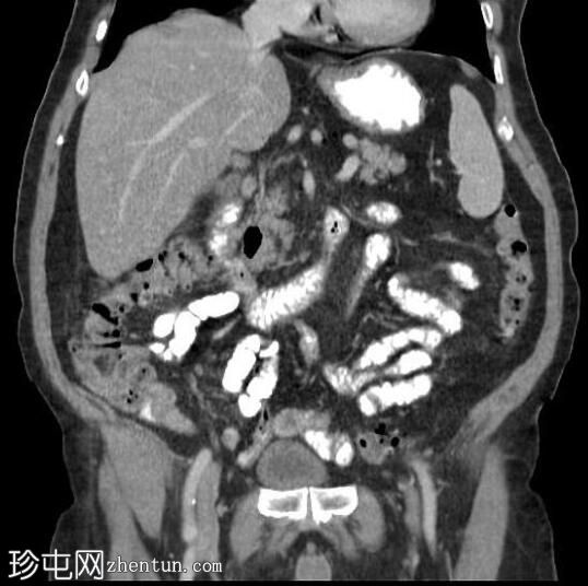 胆囊穿孔与肝脓肿形成