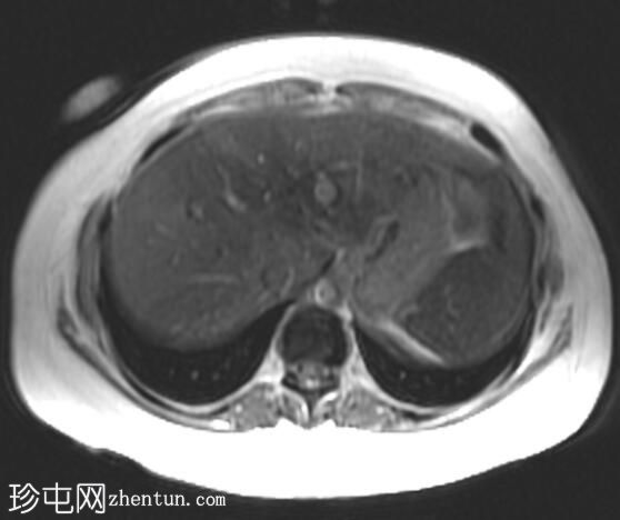 海狸尾肝(MRI)