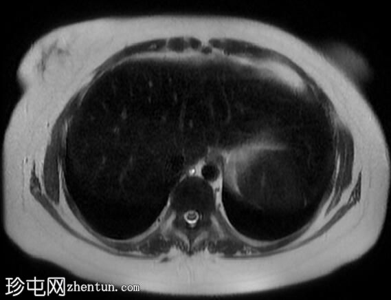 海狸尾肝(MRI)