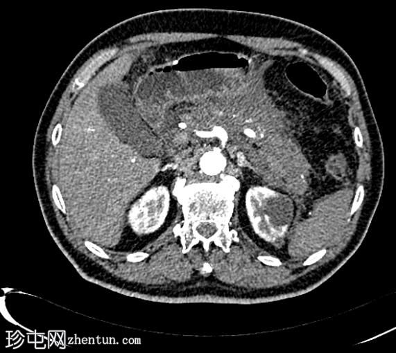 坏死性胰腺炎伴灌注不足