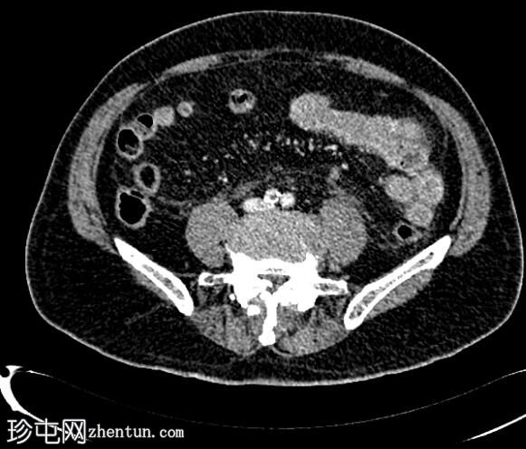 坏死性胰腺炎伴灌注不足