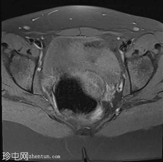 子宫内膜异位症-亲吻卵巢征