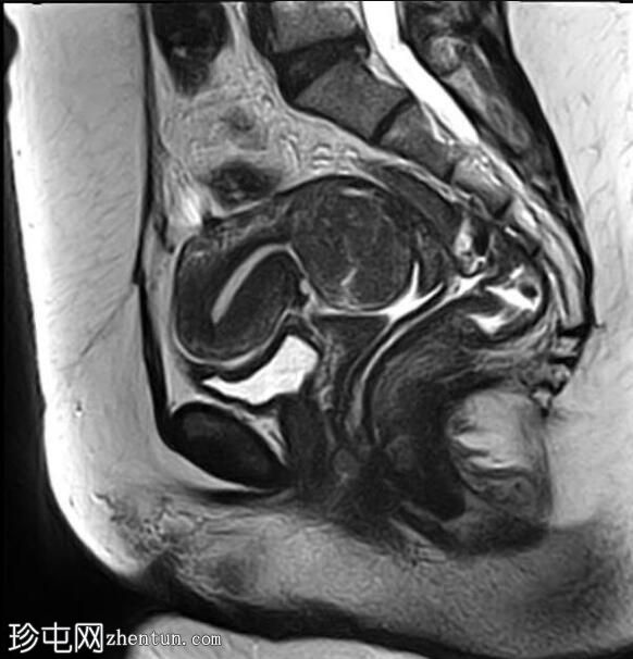 粘膜下平滑肌瘤脱垂至宫颈管内