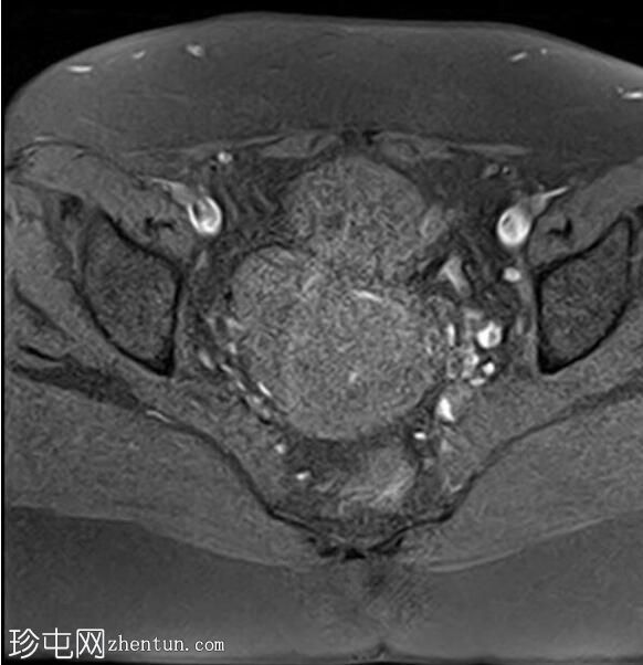 粘膜下平滑肌瘤脱垂至宫颈管内