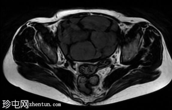 卵巢成熟囊性畸胎瘤伴浮球征