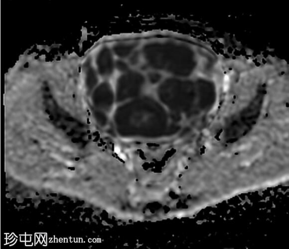 卵巢成熟囊性畸胎瘤伴浮球征