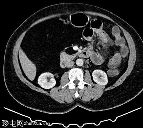 肠系膜脂肪瘤
