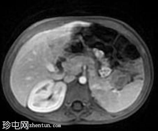 原发性胰腺神经母细胞瘤