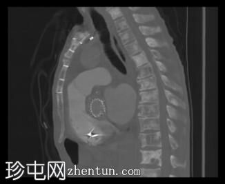 弥漫性硬化性骨骼转移