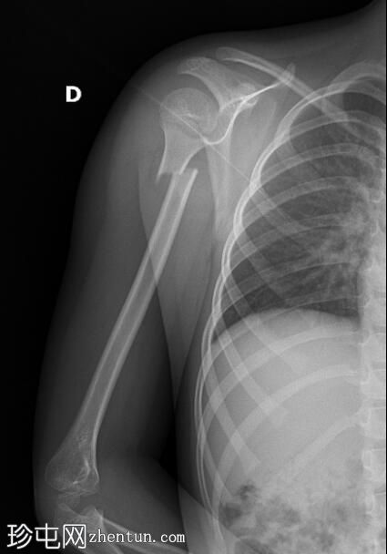 肱骨近端骨折 - 儿科
