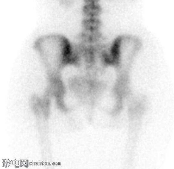 股骨颈应力性骨折（SPECT 骨扫描）