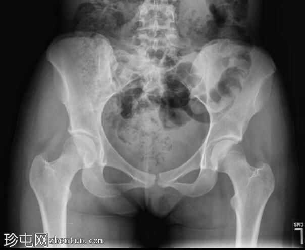 股骨颈应力性骨折（SPECT 骨扫描）