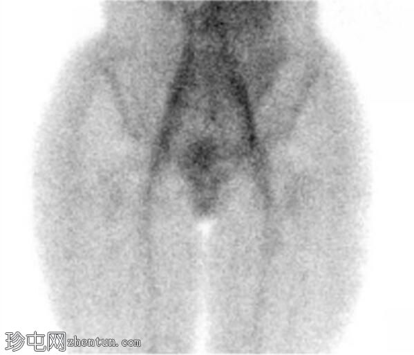 股骨颈应力性骨折（SPECT 骨扫描）