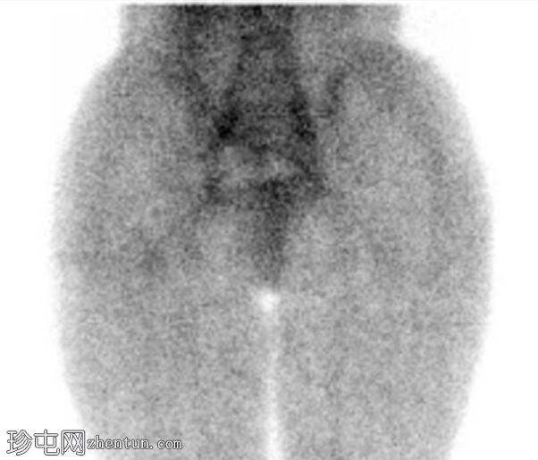 股骨颈应力性骨折（SPECT 骨扫描）