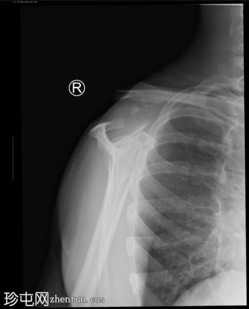 肩锁关节损伤 - Rockwood V 型