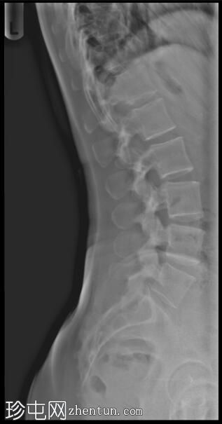 伴有六块腰椎的特发性脊柱侧凸