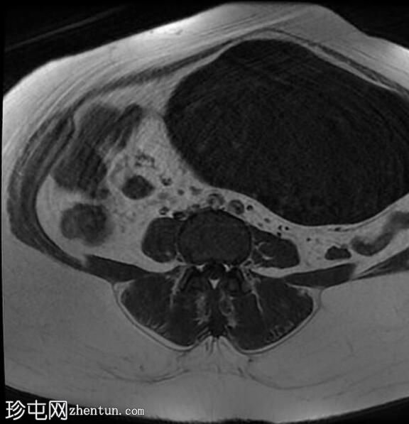 卵巢浆液性囊腺瘤