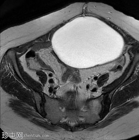 卵巢浆液性囊腺瘤