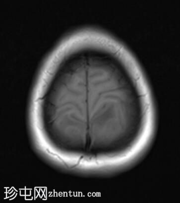 转移性绒毛膜癌伴卵巢过度刺激综合征