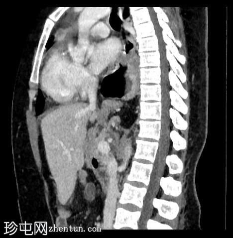 混合性食管裂孔疝 - 4 型