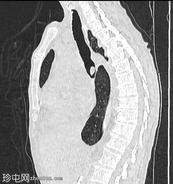 肺鳞状细胞癌和膨裂