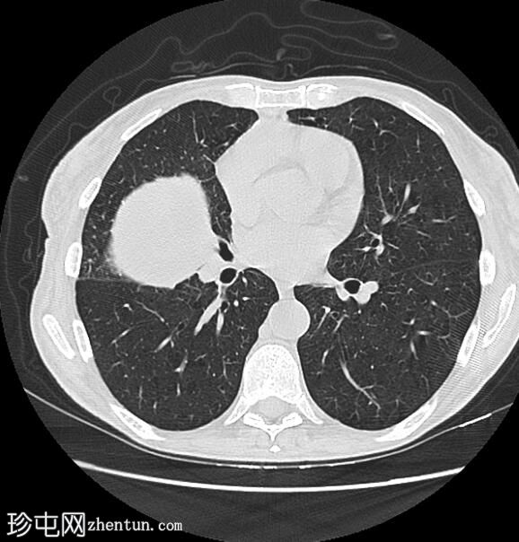 肺鳞状细胞癌和膨裂