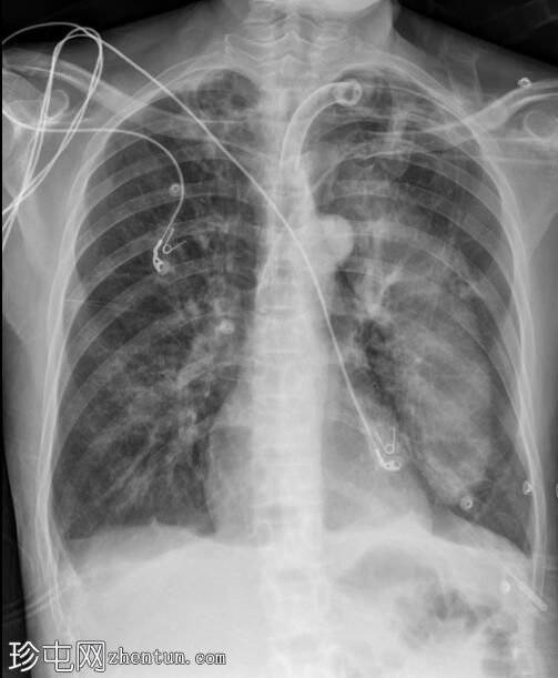 肺部假瘤