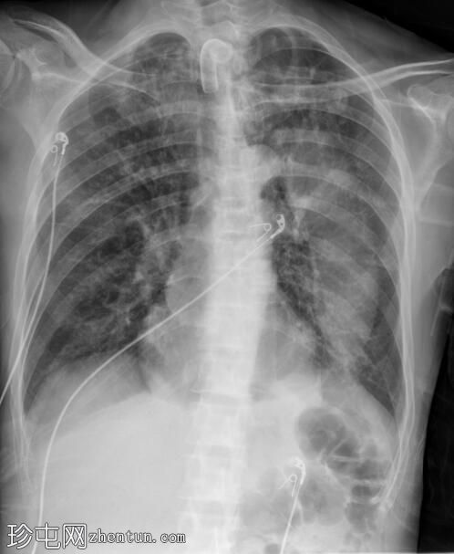肺部假瘤