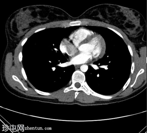 CTPA 诊断肾血管平滑肌脂肪瘤破裂导致胸膜炎性胸痛